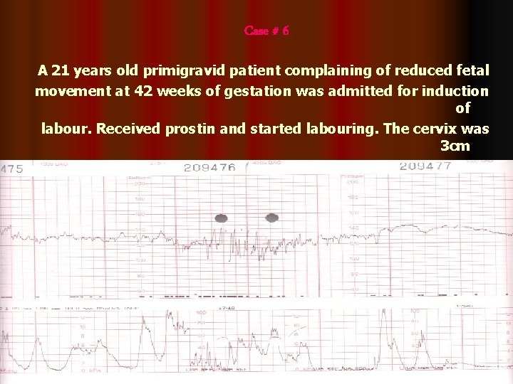 Case # 6 A 21 years old primigravid patient complaining of reduced fetal movement