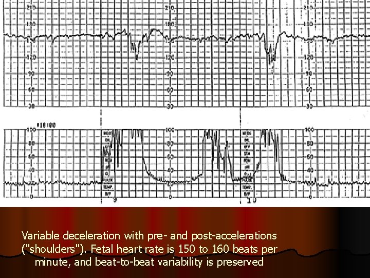 Variable deceleration with pre- and post-accelerations ("shoulders"). Fetal heart rate is 150 to 160