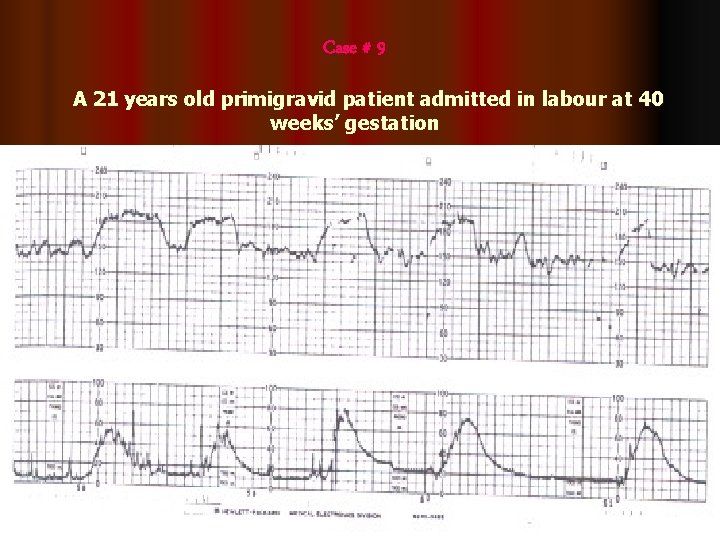 Case # 9 A 21 years old primigravid patient admitted in labour at 40