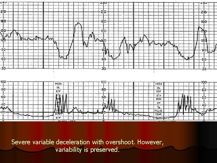 Severe variable deceleration with overshoot. However, variability is preserved. 