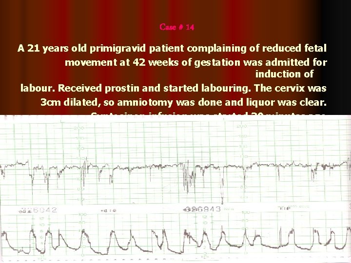Case # 14 A 21 years old primigravid patient complaining of reduced fetal movement