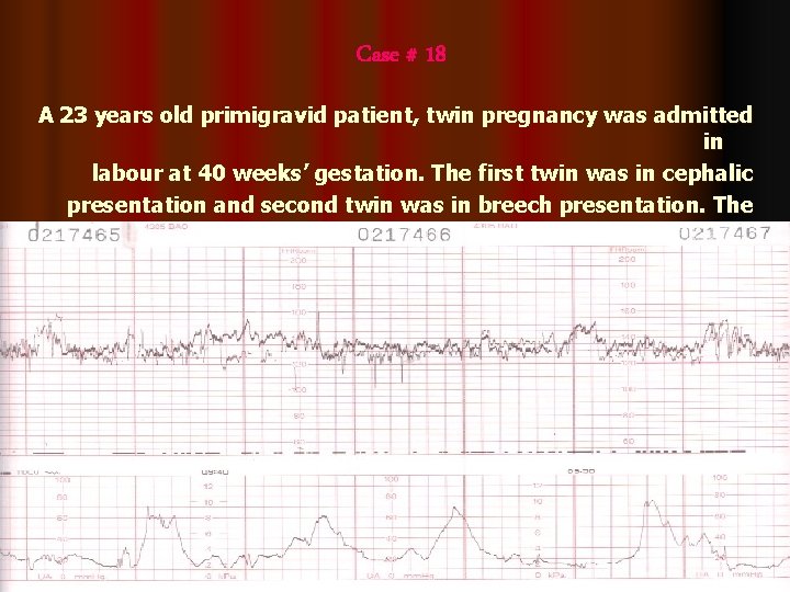 Case # 18 A 23 years old primigravid patient, twin pregnancy was admitted in