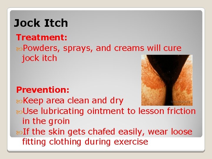 Jock Itch Treatment: Powders, sprays, and creams will cure jock itch Prevention: Keep area