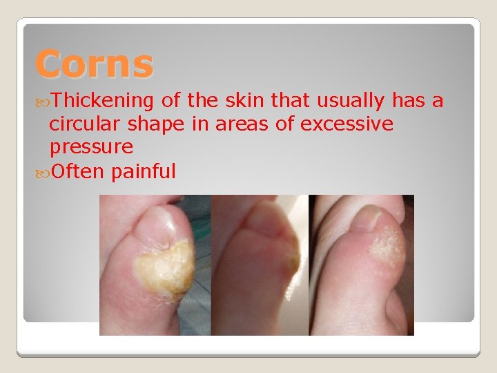 Corns Thickening of the skin that usually has a circular shape in areas of