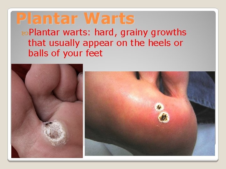 Plantar Warts Plantar warts: hard, grainy growths that usually appear on the heels or