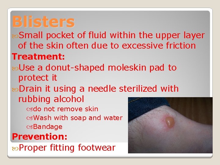 Blisters Small pocket of fluid within the upper layer of the skin often due