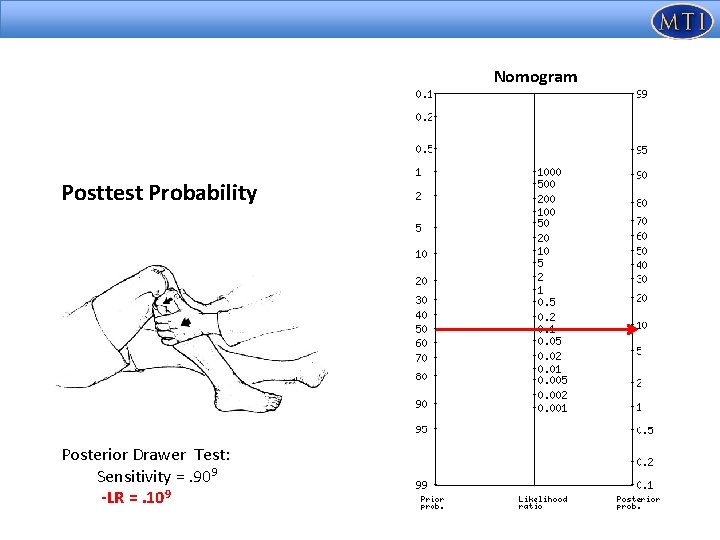 Nomogram Posttest Probability Posterior Drawer Test: Sensitivity =. 909 -LR =. 109 