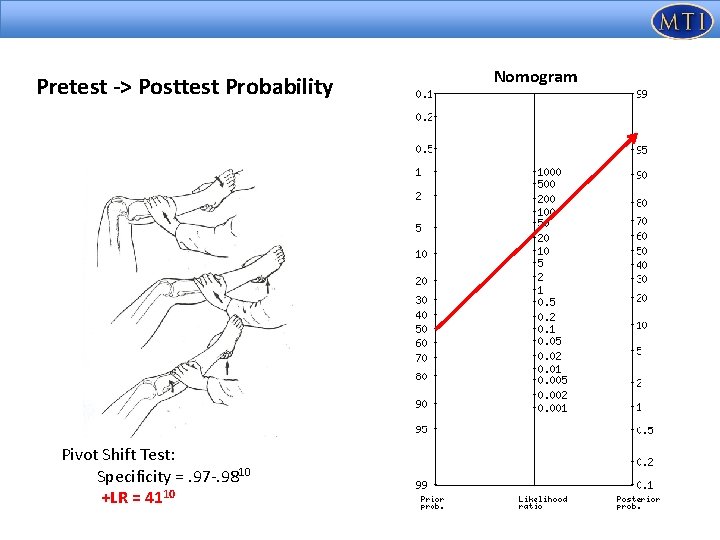 Pretest -> Posttest Probability Pivot Shift Test: Specificity =. 97 -. 9810 +LR =