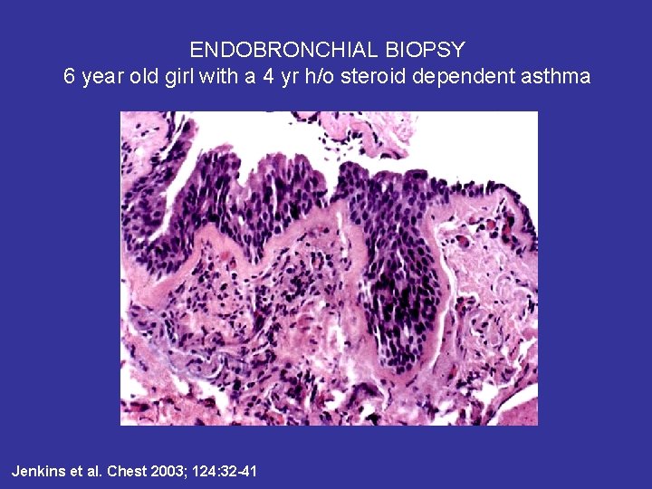 ENDOBRONCHIAL BIOPSY 6 year old girl with a 4 yr h/o steroid dependent asthma