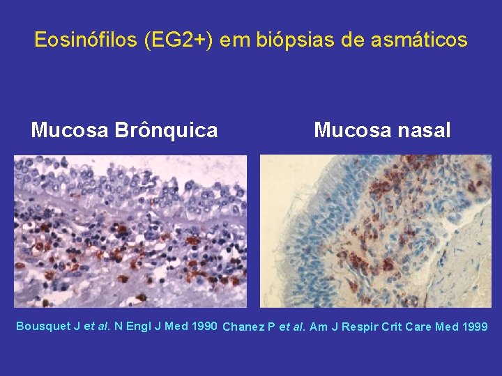 Eosinófilos (EG 2+) em biópsias de asmáticos Mucosa Brônquica Mucosa nasal Bousquet J et