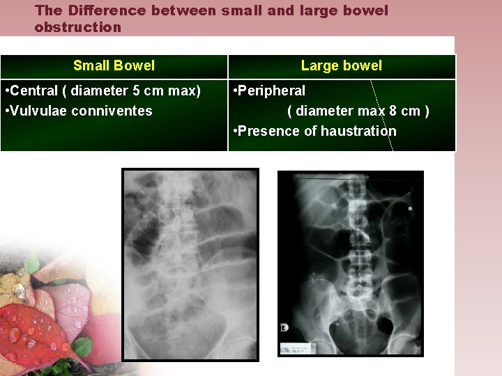 The Difference between small and large bowel obstruction Small Bowel • Central ( diameter