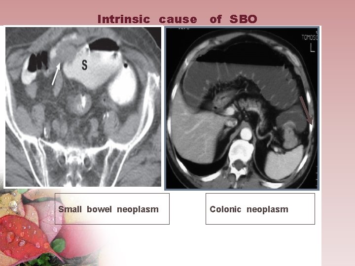 Intrinsic cause of SBO Small bowel neoplasm Colonic neoplasm 