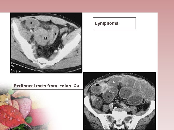 Lymphoma Peritoneal mets from colon Ca 