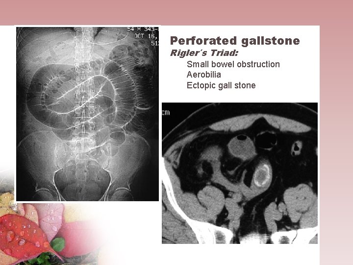Perforated gallstone Rigler´s Triad: Small bowel obstruction Aerobilia Ectopic gall stone 