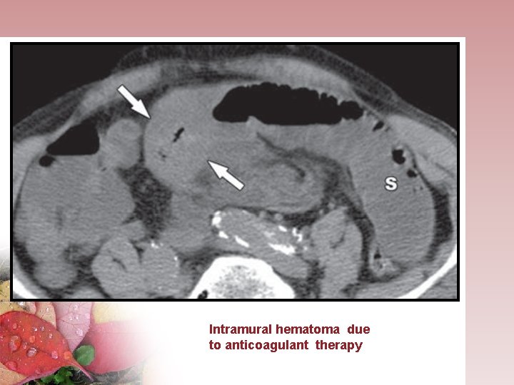 Intramural hematoma due to anticoagulant therapy 