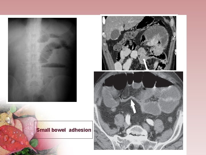 Small bowel adhesion 