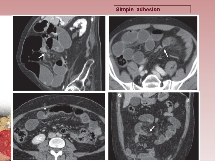 Simple adhesion 