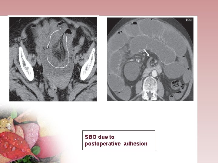 SBO due to postoperative adhesion 