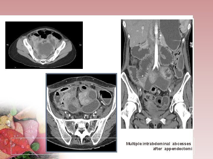 Multiple intrabdominal abcesses after appendectomi 