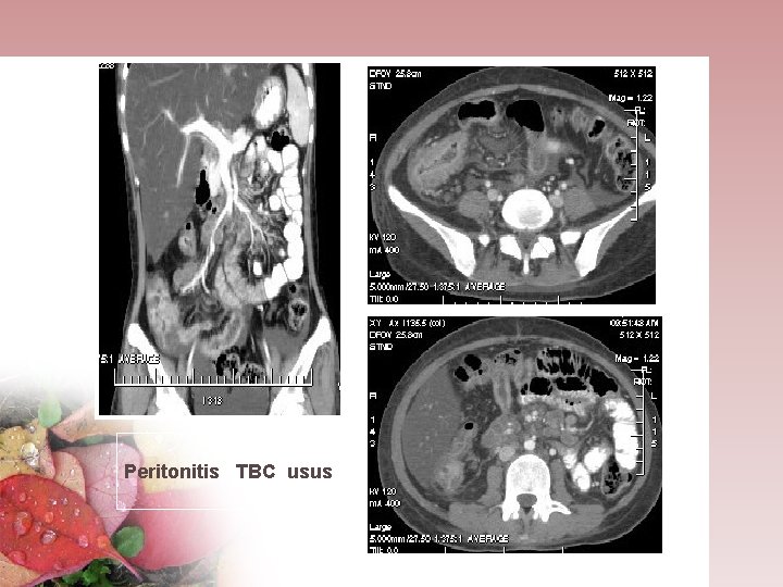 Peritonitis TBC usus 