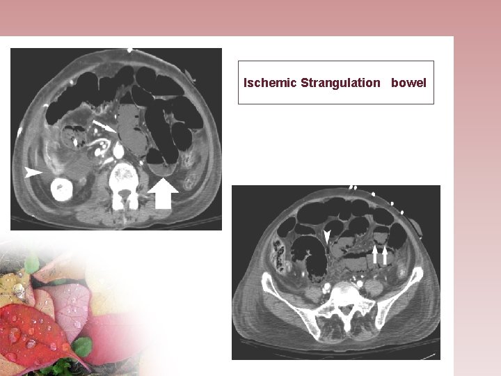 Ischemic Strangulation bowel 
