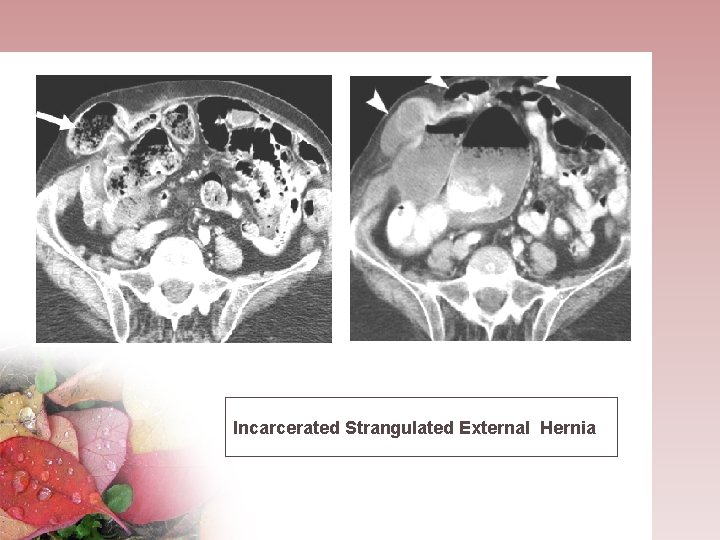 Incarcerated Strangulated External Hernia 