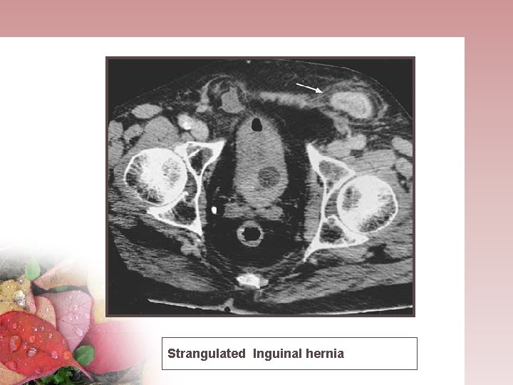 Strangulated Inguinal hernia 