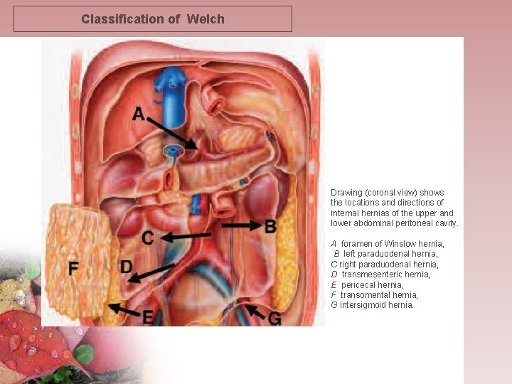 Classification of Welch Drawing (coronal view) shows the locations and directions of internal hernias