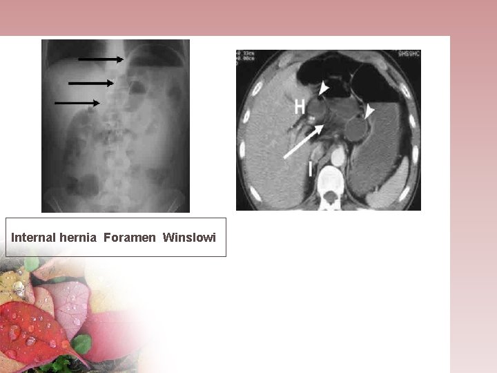 Internal hernia Foramen Winslowi 