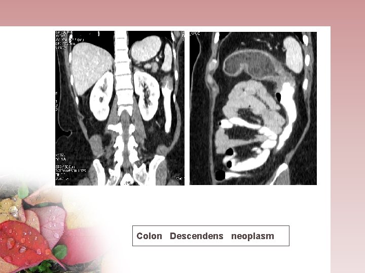 Colon Descendens neoplasm 