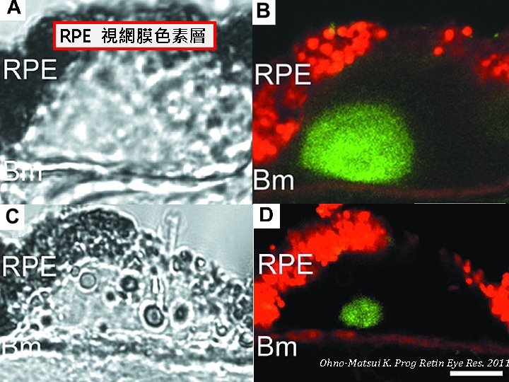 RPE 視網膜色素層 Ohno-Matsui K. Prog Retin Eye Res. 2011 