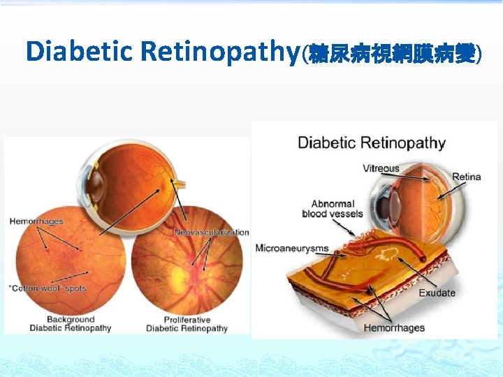 Diabetic Retinopathy(糖尿病視網膜病變) 