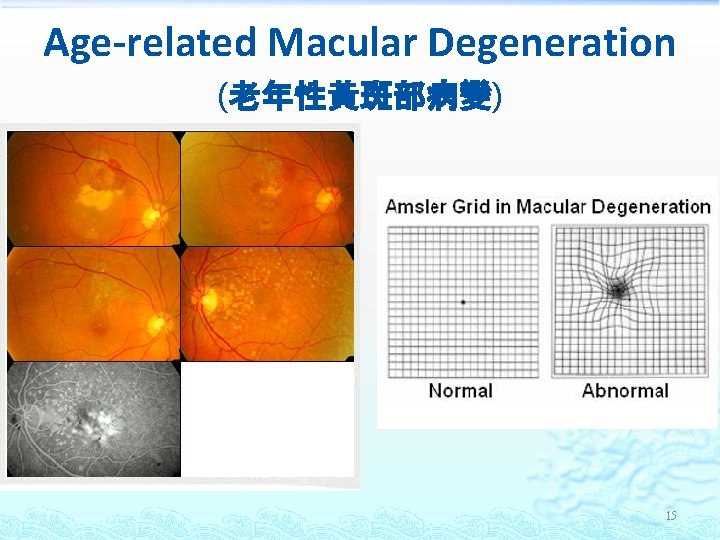 Age-related Macular Degeneration (老年性黃斑部病變) 15 