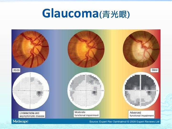 Glaucoma(青光眼) 