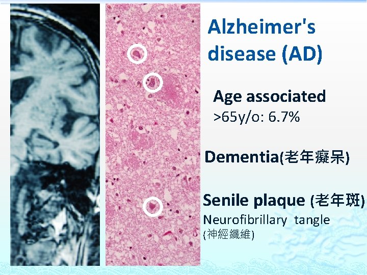 Alzheimer's disease (AD) Age associated >65 y/o: 6. 7% Dementia(老年癡呆) Senile plaque (老年斑) Neurofibrillary