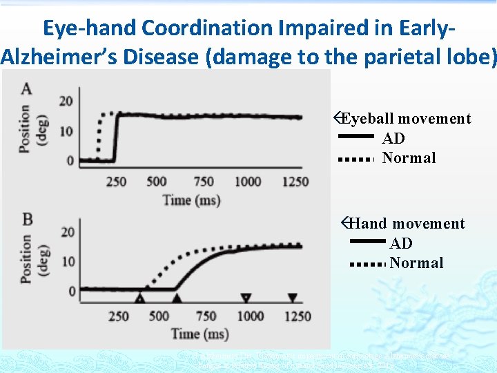 Eye-hand Coordination Impaired in Early. Alzheimer’s Disease (damage to the parietal lobe) ßEyeball movement