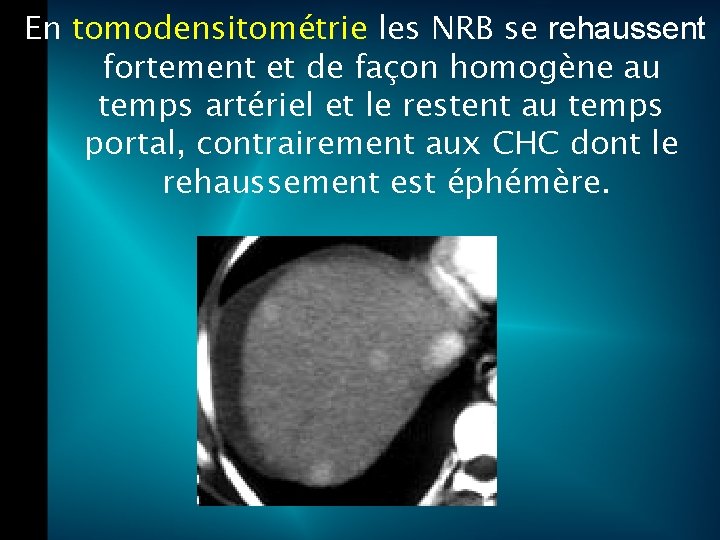 En tomodensitométrie les NRB se rehaussent fortement et de façon homogène au temps artériel
