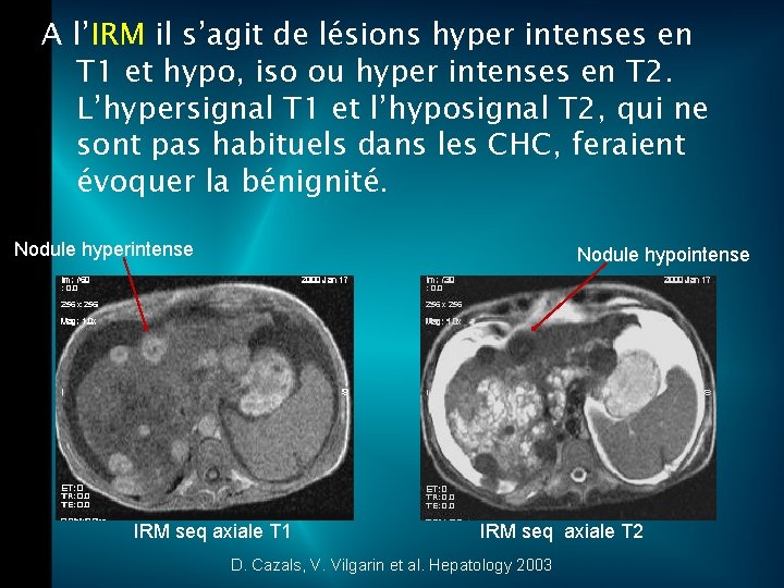 A l’IRM il s’agit de lésions hyper intenses en T 1 et hypo, iso