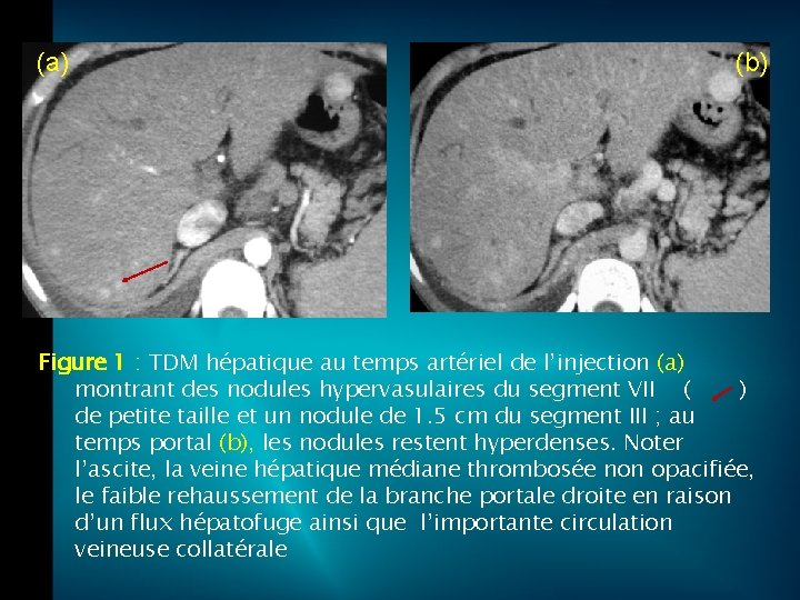 (a) (b) Figure 1 : TDM hépatique au temps artériel de l’injection (a) montrant