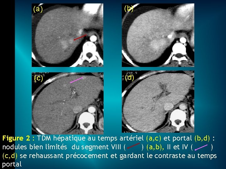 (a) (b) (c) (d) Figure 2 : TDM hépatique au temps artériel (a, c)