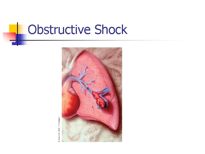 Obstructive Shock 