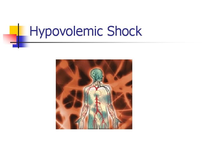 Hypovolemic Shock 