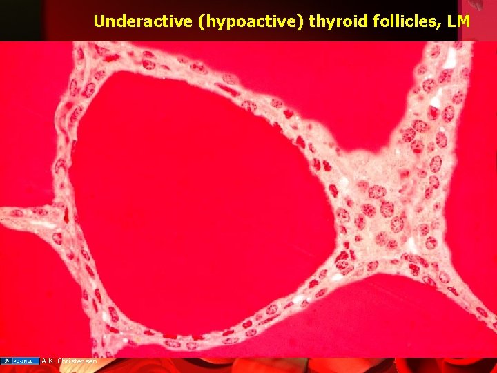 Underactive (hypoactive) thyroid follicles, LM A. K. Christensen 