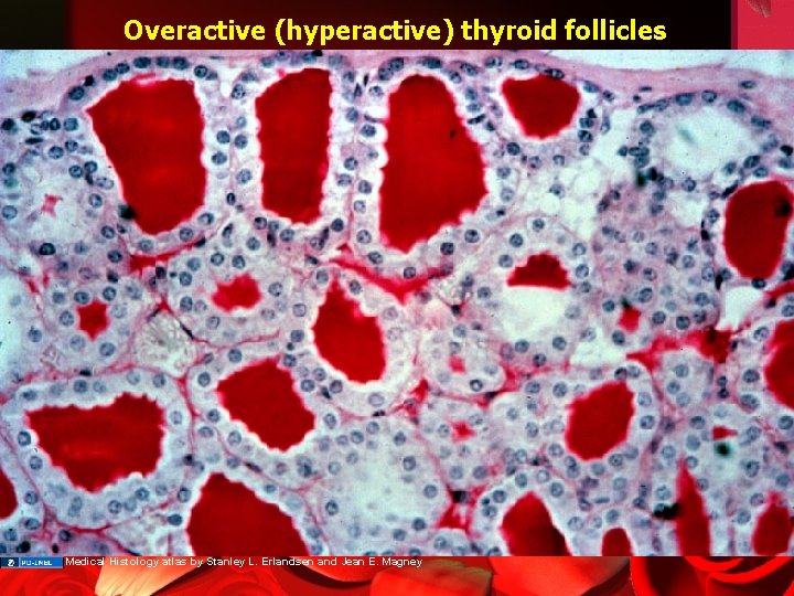 Overactive (hyperactive) thyroid follicles Medical Histology atlas by Stanley L. Erlandsen and Jean E.