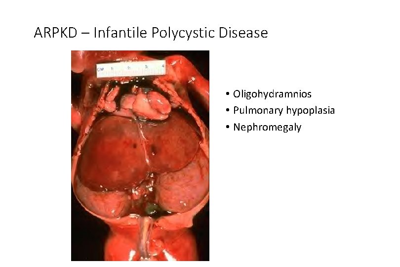 ARPKD – Infantile Polycystic Disease • Oligohydramnios • Pulmonary hypoplasia • Nephromegaly 