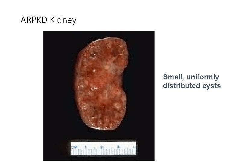 ARPKD Kidney Small, uniformly distributed cysts 
