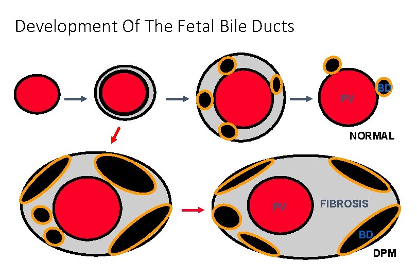 Development Of The Fetal Bile Ducts BD PV NORMAL PV FIBROSIS BD DPM 
