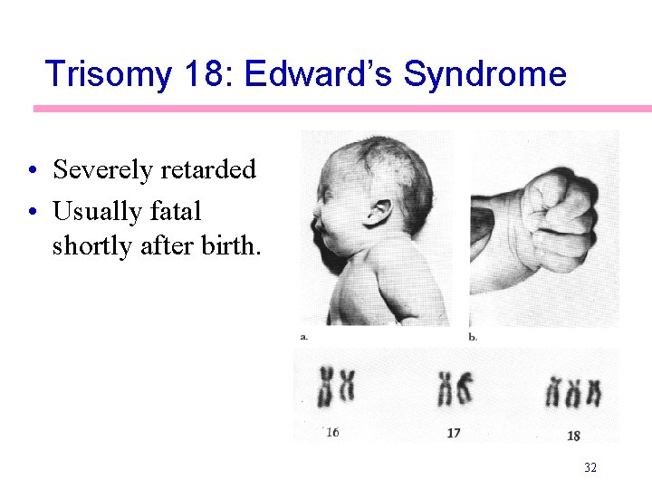 Trisomy 18: Edward’s Syndrome • Severely retarded • Usually fatal shortly after birth. 32