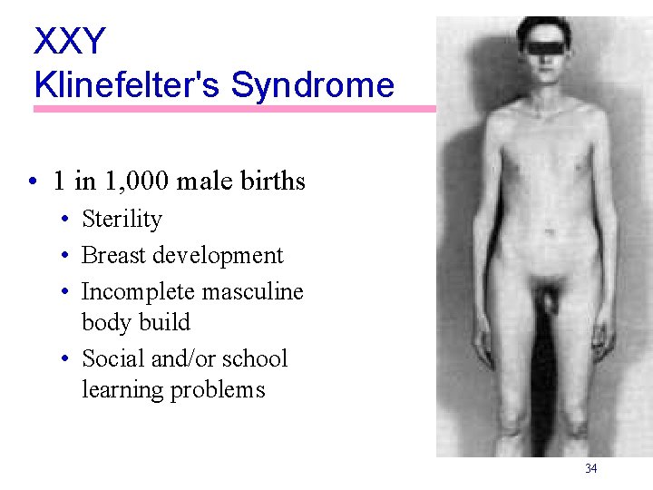 XXY Klinefelter's Syndrome • 1 in 1, 000 male births • Sterility • Breast