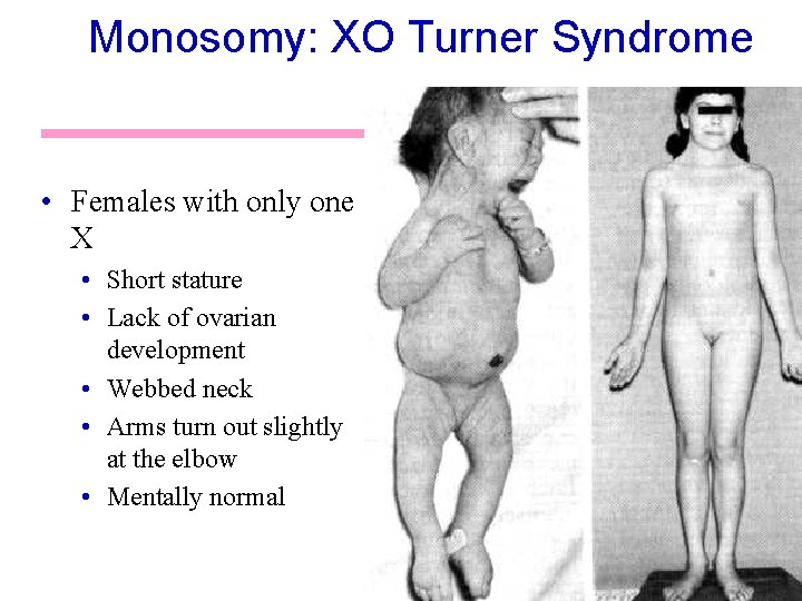 Monosomy: XO Turner Syndrome • Females with only one X • Short stature •